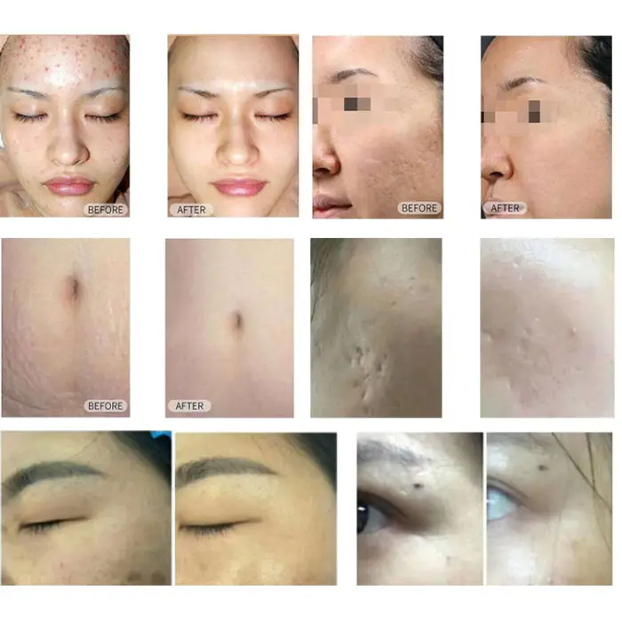 60W Stationary CO2 Fractional Laser Machine for Face Skin Resurfacing and Stretch Scar Removal — image 7