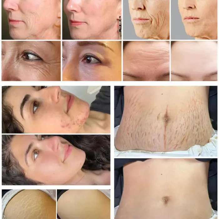 RF Microneedle for Jawline Definition Non Surgical Face Lift RF Microneedle Needles Cartridge Cooling Machine — image 7