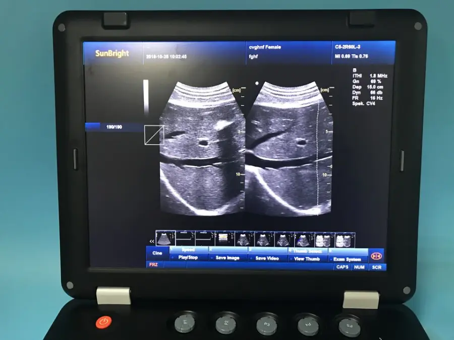 Portable 3d Ultrasound for Medical Diagnostic Imaging Center Using Veterinary Human Color Ultrasound for Gynecology — image 4