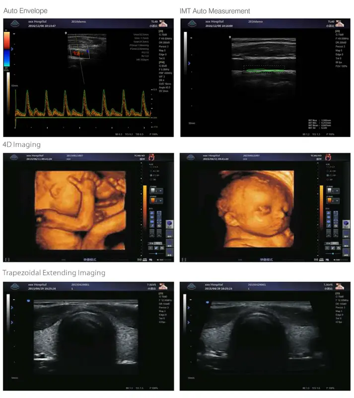 Abdomen Gynecology Obstetrics 4D Color Doppler Ultrasound Trolley Machine for Human & Animal Use — image 5