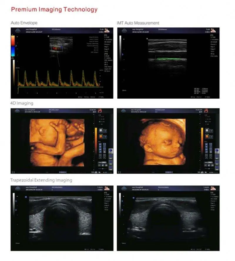 Zoncare Hot Selling Trolley Medical Color Doppler 3D 4D Ultrasound Machine for Hospital — image 6