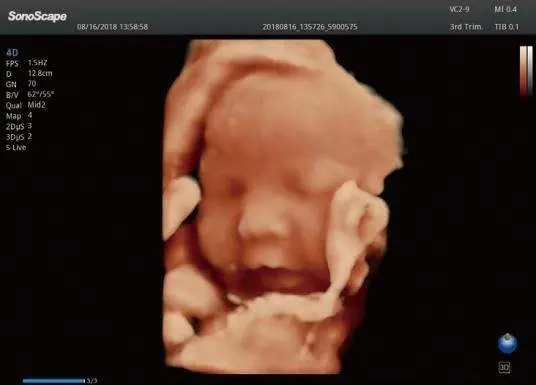 Sonoscape P50 Elite 4D 5D Medical Ultrasound Scanner for Obstetrics Gynecology Cardiovascular Urology — image 5