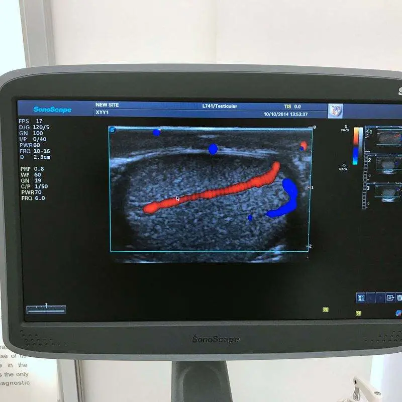 Medical Ultrasound Instruments Sonoscape S22 Sonoscape Ultrasound Machine — image 5