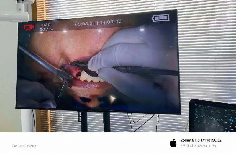 Surgical 4K HD Camera Headlight and Headcam with Camera Medical 4k HD Camera for Surgery — image 5