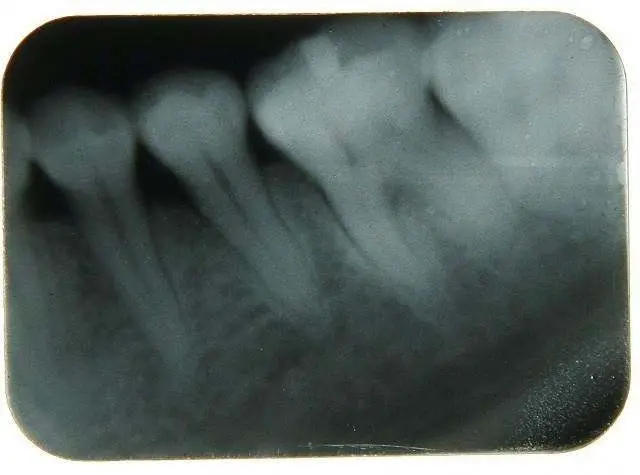 Good Quality Dental Xray Dental Sensor X-ray Digital Dental X-ray Machine — image 5