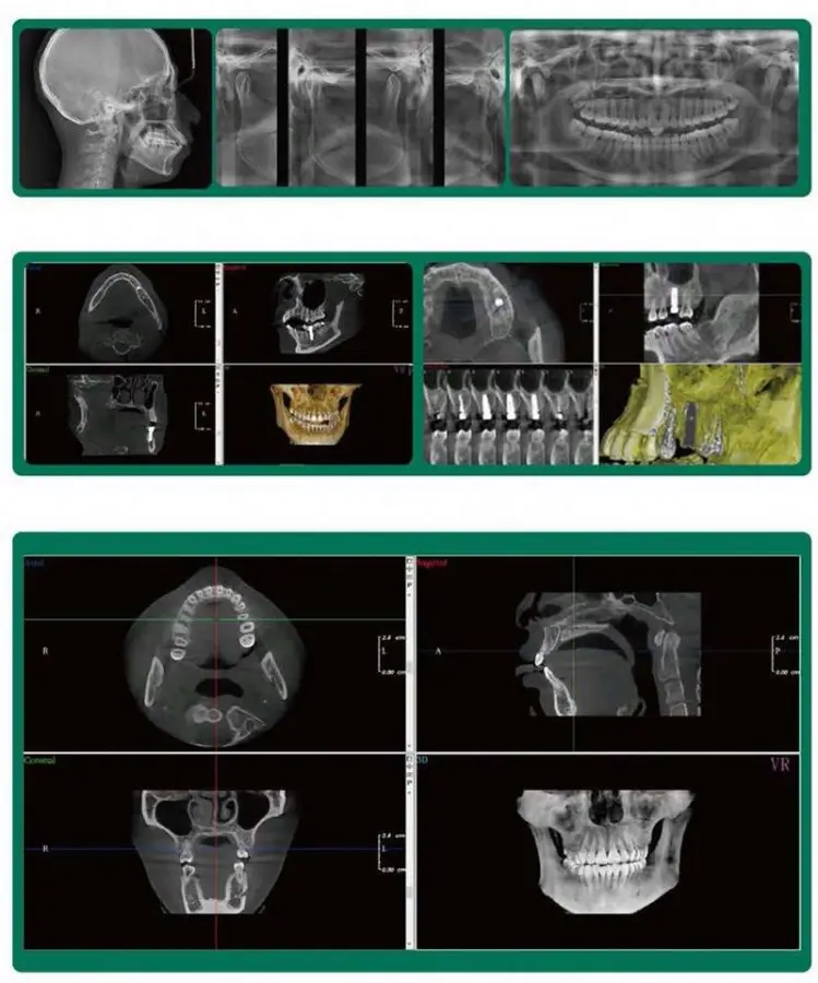 Dental Digital CBCT 3D Panoramic Dental Cephalometric X Ray Machine Digital Dental OPG Panoramic 3D X Ray Tomographic System — image 3
