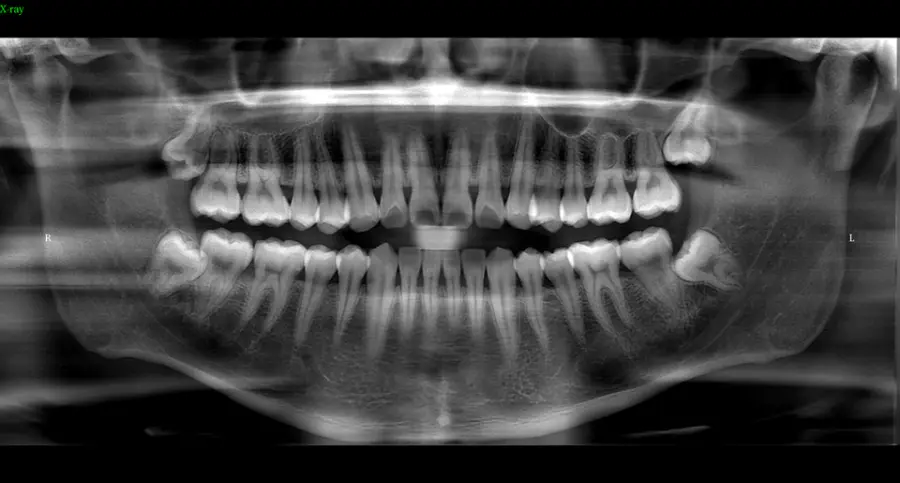 Hospital 2D or 3D OPG Digital Panoramic Mouth Unit CBCT Dental Xray Machine With Cephalometric Function for Dental — image 5